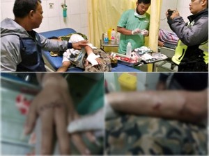 Diserang Pemuda Mabuk di Sukabumi, Jari Yatna Nyaris Putus