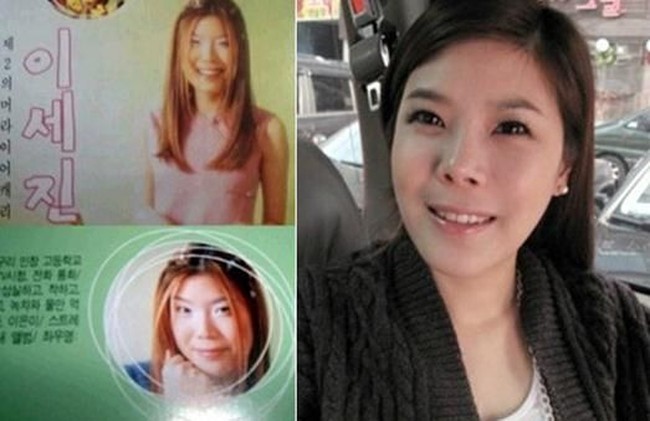 Beginilah penampilannya dulu sebelum rhinoplasty atau operasi hidung. Foto: ist