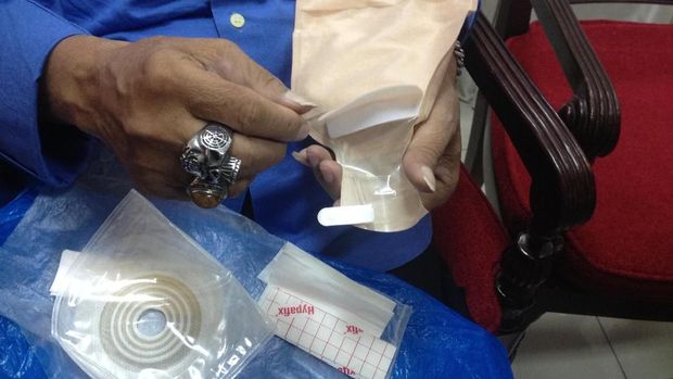 Sebagian pengidap kanker kolorektal harus memakai kantong di perut untuk pembuangan kotoran. Ini kisah Umbu, salah satu pasien yang harus hidup 'berkantong'.
