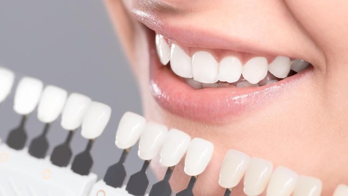 Veneer gigi merupakan tindakan medis yang harus dilakukan oleh dokter gigi profesional. (Foto: thinkstock) Veneer gigi merupakan tindakan medis yang harus dilakukan oleh dokter gigi profesional. (Foto: thinkstock)