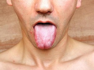 Indera Perasa di Lidah Pria Ini Hilang, Apa Penyebabnya?