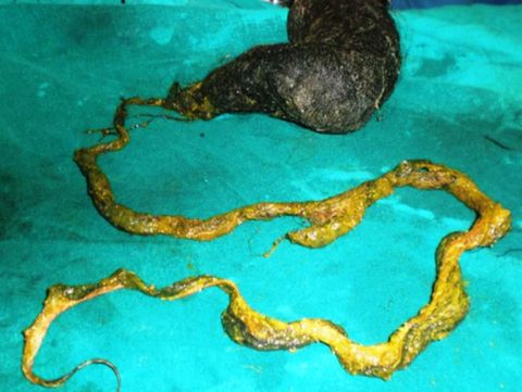 Gulungan rambut ini ditemukan dalam perut gadis 6 tahun di India
