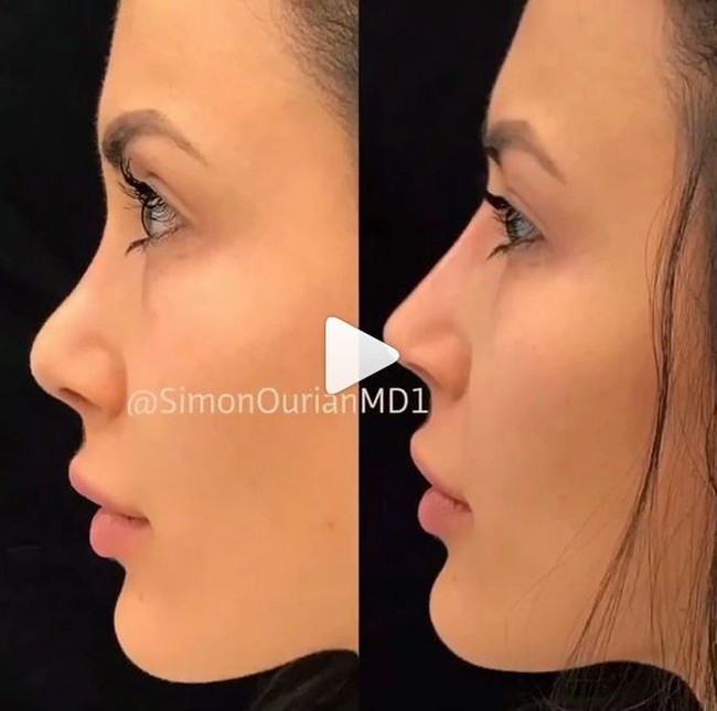 Dr. Simon Ourian mengubah tulang hidung wanita ini yang tadinya tidak lancip menjadi lebih lancip. Alhasil hidung pasien wanita yang sudah cantik ini pun terlihat mancung sempurna melalui tindakan non-surgical nose job. Foto: Instagram Dr. Simon Ourian