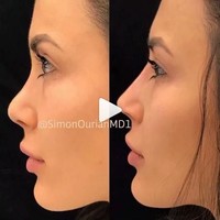 Dr. Simon Ourian mengubah tulang hidung wanita ini yang tadinya tidak lancip menjadi lebih lancip. Alhasil hidung pasien wanita yang sudah cantik ini pun terlihat mancung sempurna melalui tindakan non-surgical nose job. Foto: Instagram Dr. Simon Ourian