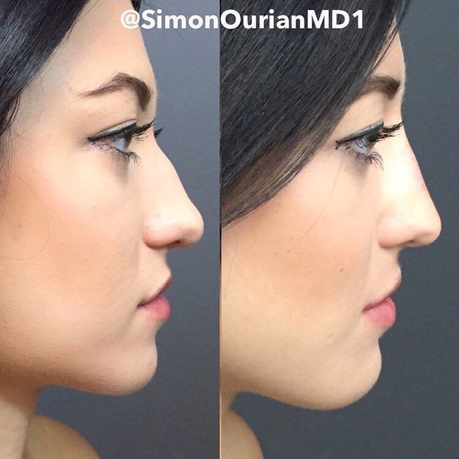 Wanita ini mengubah hidungnya yang tulang bagian atasnya bengkok dan tidak mancung, menjadi mancung sempurna melalui tindakan suntik filler. Foto: Instagram Dr. Simon Ourian