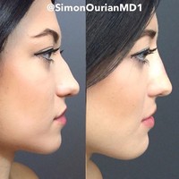 Wanita ini mengubah hidungnya yang tulang bagian atasnya bengkok dan tidak mancung, menjadi mancung sempurna melalui tindakan suntik filler. Foto: Instagram Dr. Simon Ourian