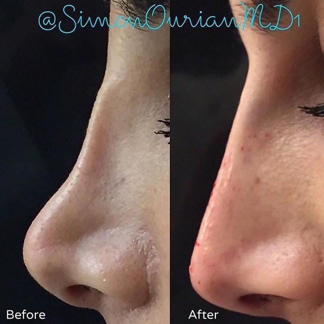 Wanita yang mengubah bentuk hidungnya ini harus menghabiskan biaya mulai dari US$ 2.900 - US$ 6.900 atau sekitar Rp 40 juta hingga Rp 95 juta. Dan pasien juga harus melakukan konsultasi dulu dengan sang dokter yang biayanya US$ 500 atau sekitar Rp 6,8 juta. Foto: Instagram Dr. Simon Ourian