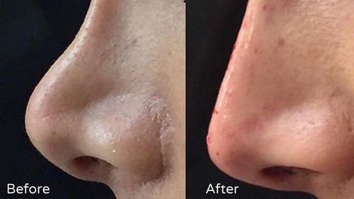 hidung wanita pesek jadi mancung