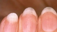 Normalnya kuku yang sehat terlihat mulus tidak ada patahan atau sobekan. Tapi kalau kuku tumbuh dengan tekstur yang tidak rata atau berlubang bisa jadi ini karena gejala peradangan atau psoriasis. (Foto: 9gag)