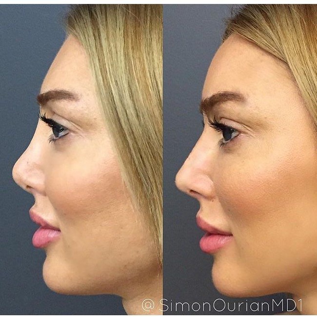 Wanita di foto ini sebelumnya sudah melakukan tindakan non bedah pada hidungnya di beberapa dokter. Namun dia merasa tidak puas dengan hasilnya. Dia pun mengubah hidungnya lagi yang kini tulang bagian atasnya menjadi lebih tegas. Foto: Instagram Dr. Simon Ourian
