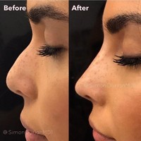 Hidung wanita ini yang awalnya sedikit besar berubah menjadi kecil lewat tindakan non bedah yang dilakukan dokter langganan para selebriti Hollywood mulai dari Kim Kardashian hingga Angelina Jolie. Foto: Instagram Dr. Simon Ourian