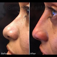 Untuk mengubah hidung dari pesek menjadi mancung ini, Dr. Simon Ourian yang juga menjadi langganan penyanyi Indonesia, Agnez Mo, ini mengaku hanya butuh waktu 15 menit. Foto: Instagram Dr. Simon Ourian