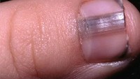 Garis hitam pada kuku sebaiknya diperiksa karena bisa jadi tanda kanker kulit melanoma. (Foto: 9gag)