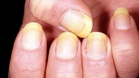Kuku kuning bisa jadi karena penyakit paru, tiroid, psoriasis, infeksi jamur, hingga penyakit hati. (Foto: 9gag)