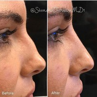 Perubahan hidung wanita ini dilakukan melalui suntik filler pada bagian hidung yang dilakukan oleh bedah plastik langganan keluarga Kardashian, Dr. Simon Ourian. Foto: Instagram Dr. Simon Ourian