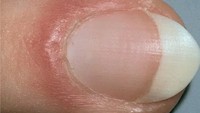 Kulit disekitar kuku yang tampak menebal bisa jadi karena ada infeksi. (Foto: 9gag)