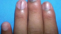 Kuku pucat dengan sedikit warna biru bisa jadi karena tidak mendapat suplai oksigen yang cukup dari darah. Ini merupakan tanda-tanda penyakit pembuluh darah atau masalah paru. (Foto: 9gag)