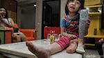 Mengintip Bengkel Tangan dan Kaki Palsu