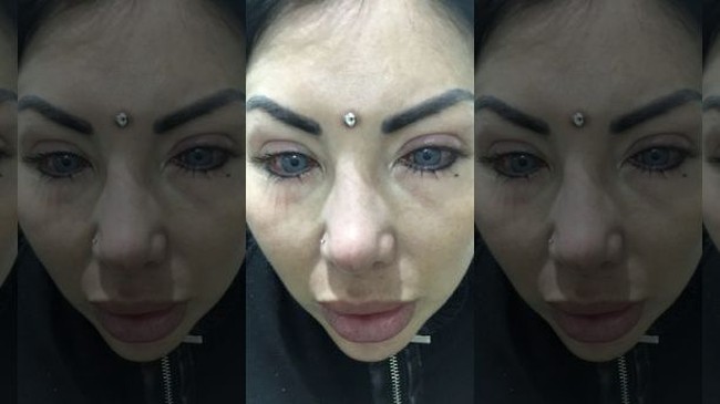 Nadinne Bruna asal Miami, Florida, baru berusia 32 tahun. Tapi kini kondisi penglihatannya seperti seorang nenek 90 tahun. Penyebabnya karena operasi untuk mengganti warna matanya dari hazel jadi abu-abu. Setelah operasi, penglihatannya semakin kabur, menjadi merah serta sakit berbulan-bulan. Akibat pemasangan implan pada matanya, Nadinne kehilangan 80 persen penglihatan di mata kanan. Sementara mata kiri kehilangan 50 persen penglihatan. Foto: Instagram