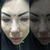 Nadinne Bruna asal Miami, Florida, baru berusia 32 tahun. Tapi kini kondisi penglihatannya seperti seorang nenek 90 tahun. Penyebabnya karena operasi untuk mengganti warna matanya dari hazel jadi abu-abu. Setelah operasi, penglihatannya semakin kabur, menjadi merah serta sakit berbulan-bulan. Akibat pemasangan implan pada matanya, Nadinne kehilangan 80 persen penglihatan di mata kanan. Sementara mata kiri kehilangan 50 persen penglihatan. Foto: Instagram