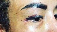 Cynthiara Alona mengunggah foto dirinya nampak luka dan lebam pada bagian mata yang diduga akibat prosedur sulam alis dan bulu mata. (Dok. Instagram/cynthiara_alona)