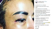 Bahkan ada yang menyebut alisnya lebih menyeramkan dari luka tersebut. (Dok. Instagram/cynthiara_alona)