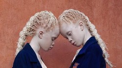 Lara dan Mara Bawar merupakan kembar albino yang langka, diperkirakan hanya ada 1 : 17 ribu di dunia! Ini potret cantik dari si Rare Flowers.