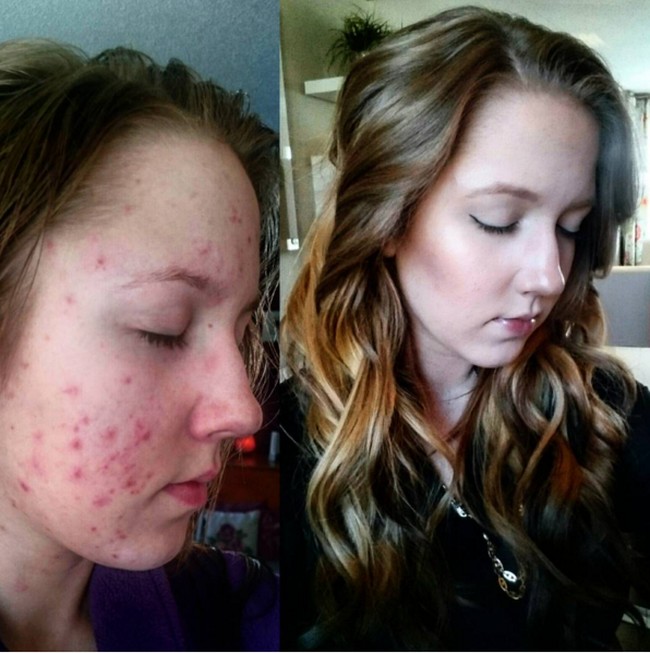 Jerawat parah dengan merah-merah yang terlihat jelas jadi tampak mulus berkat concealer. Foto: Instagram/@lil_kaitie