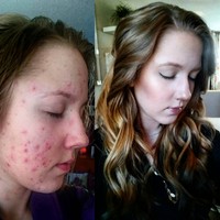 Jerawat parah dengan merah-merah yang terlihat jelas jadi tampak mulus berkat concealer. Foto: Instagram/@lil_kaitie