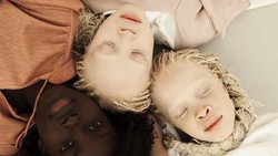 Lara dan Mara Bawar merupakan kembar albino yang langka, diperkirakan hanya ada 1 : 17 ribu di dunia! Ini potret cantik dari si Rare Flowers.