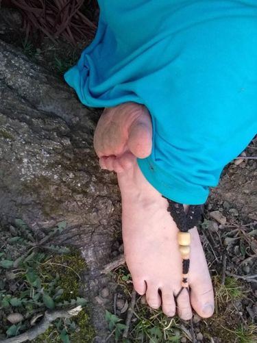 3 Tahun Nyeker Tak Pakai Sepatu, Kaki Kassandra Jadi Seperti Ini