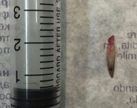 Besar kuku ekstra sang pria ketika sudah diangkat.