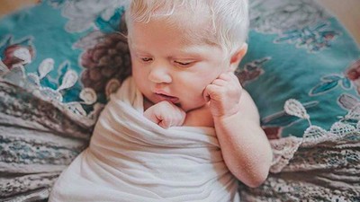 Nora, si Bayi Elsa Frozen yang Berambut Putih karena Albino