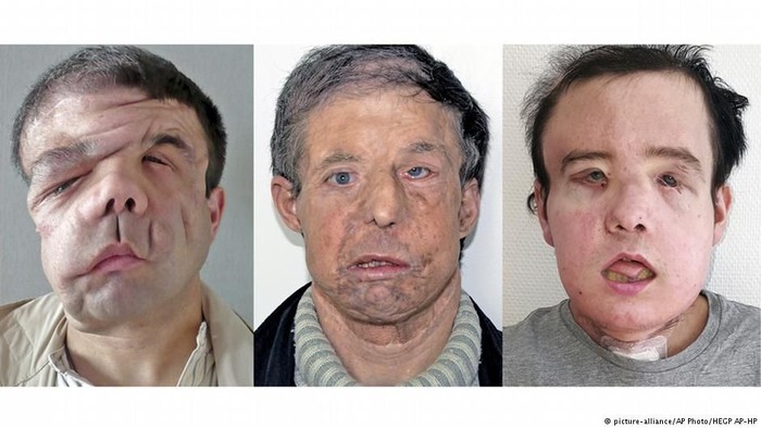 Akibat Penyakitnya, Pria Prancis Ini Punya Tiga Wajah Berbeda