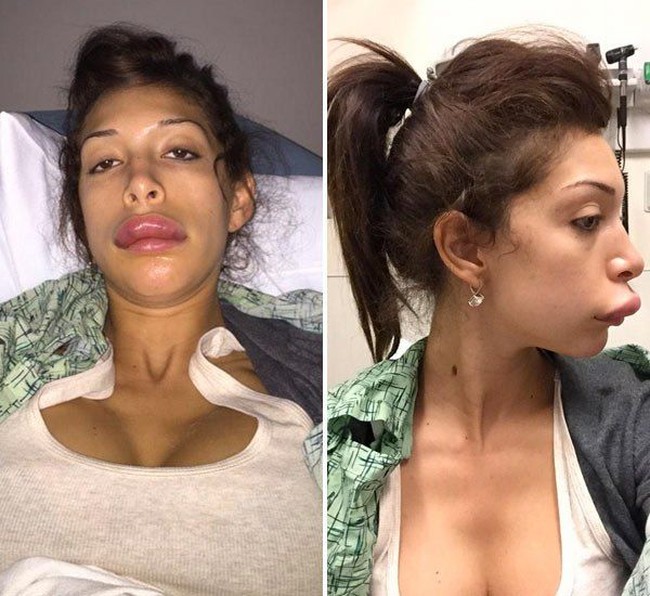 Karena obsesi ingin punya bibir seksi bak Kylie Jenner, bibir Farrah malah jontor.  Foto: dok. Instagram