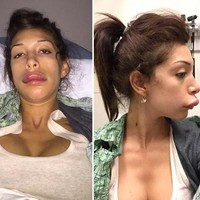 Karena obsesi ingin punya bibir seksi bak Kylie Jenner, bibir Farrah malah jontor.  Foto: dok. Instagram