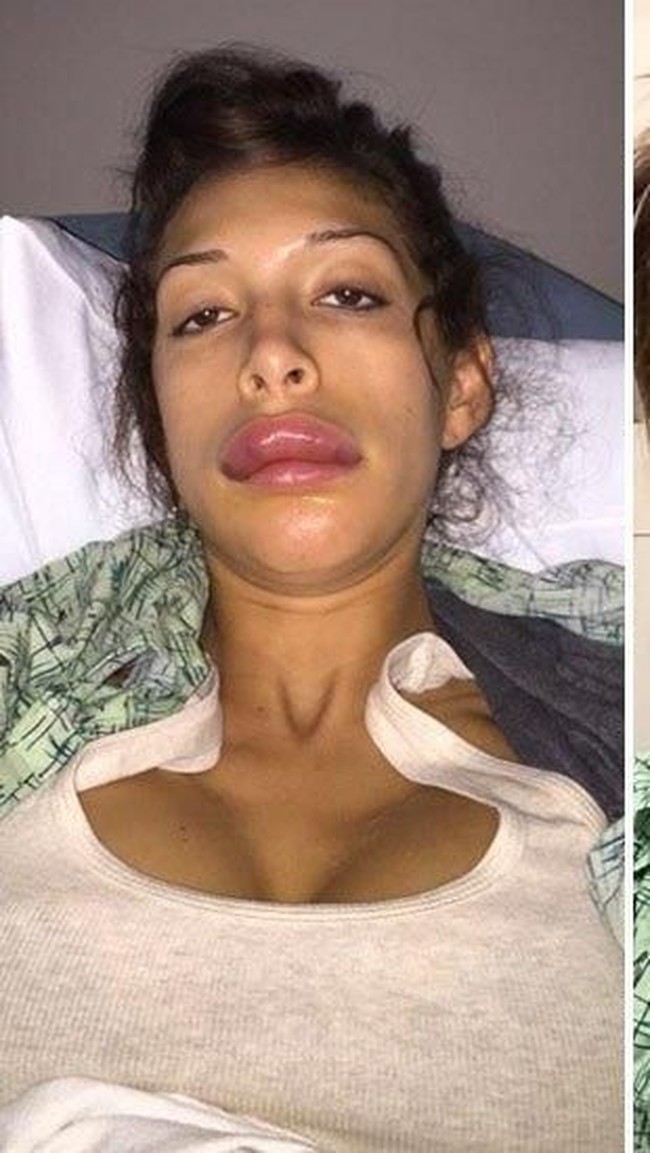 Saat itu, Farrah alergi dengan cairan filler. Bukannya jadi seksi, penampilan bibirnya malah bengkak seperti disengat tawon.  Foto: dok. Instagram