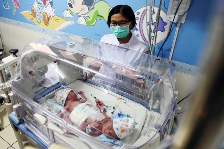 RSHS Rawat Bayi Kembar Siam Berkaki Tiga RSHS Rawat Bayi Kembar Siam Berkaki Tiga