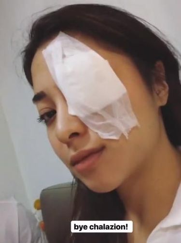 Ditutup Perban, Mata Nikita Willy Kenapa?