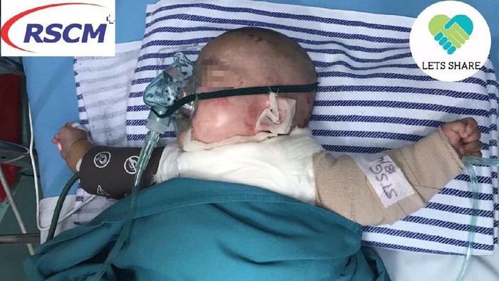 Bayi Dilan dirawat di RSCM sekitar 20 hari lamanya (Foto: lets share) Bayi Dilan dirawat di RSCM sekitar 20 hari lamanya (Foto: lets share)