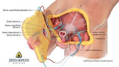 Foto: Begini Cara Dokter Lakukan Transplantasi Penis Utuh Pertama di Dunia