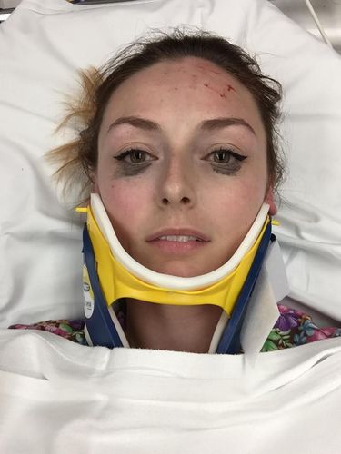 Wajah Memar Habis Kecelakaan Mobil, Wanita Ini Malah Pamer Eyeliner 