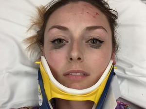 Wajah Memar Habis Kecelakaan Mobil, Wanita Ini Malah Pamer Eyeliner