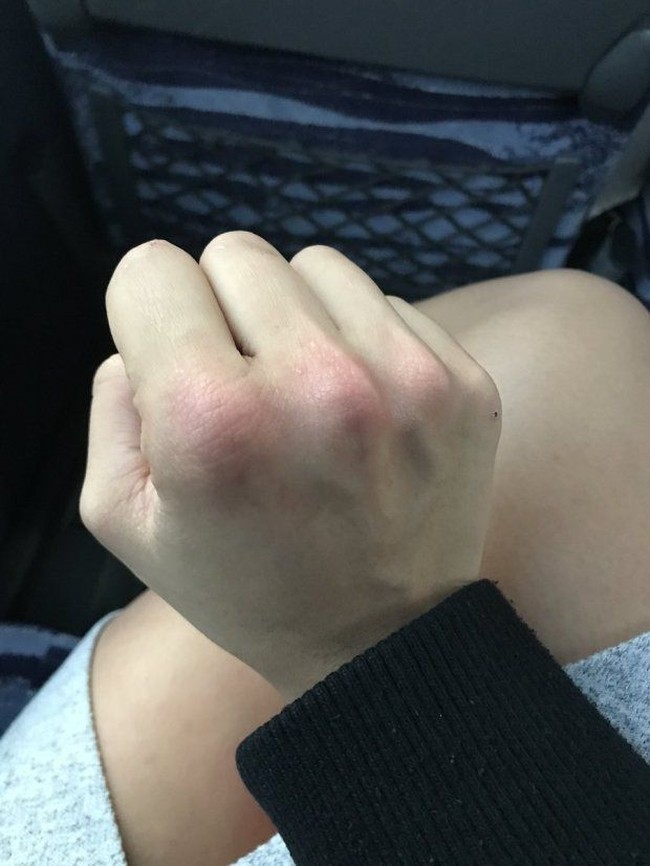 Traveling sendirian membuatku jadi orang yang lebih baik karena reaksi pertamaku adalah menonjok wajahnya, cerita wanita asal 26 tahun ini, sambil memperlihatkan tulang-tulang jarinya yang bengkak dan memerah karena tonjokan tersebut. Foto: Instagram/@leanna_carr