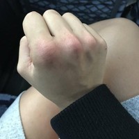 Traveling sendirian membuatku jadi orang yang lebih baik karena reaksi pertamaku adalah menonjok wajahnya, cerita wanita asal 26 tahun ini, sambil memperlihatkan tulang-tulang jarinya yang bengkak dan memerah karena tonjokan tersebut. Foto: Instagram/@leanna_carr