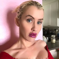 Setelah melakukan pembesaran payudara, ia pun memiliki obesesi lainnya. Katie mulai melakukan botox dan filler bibir.  Foto: Instagram