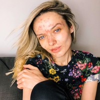 Beauty vlogger bernama Em Ford populer karena video tentang jerawatnya di 2015. Dengan video berjudul You Look Disgusting, Em memberikan video inspiratif perihal komentar buruk dari netizen tentang penampilannya. Foto: Dok. Instagram/Em Ford