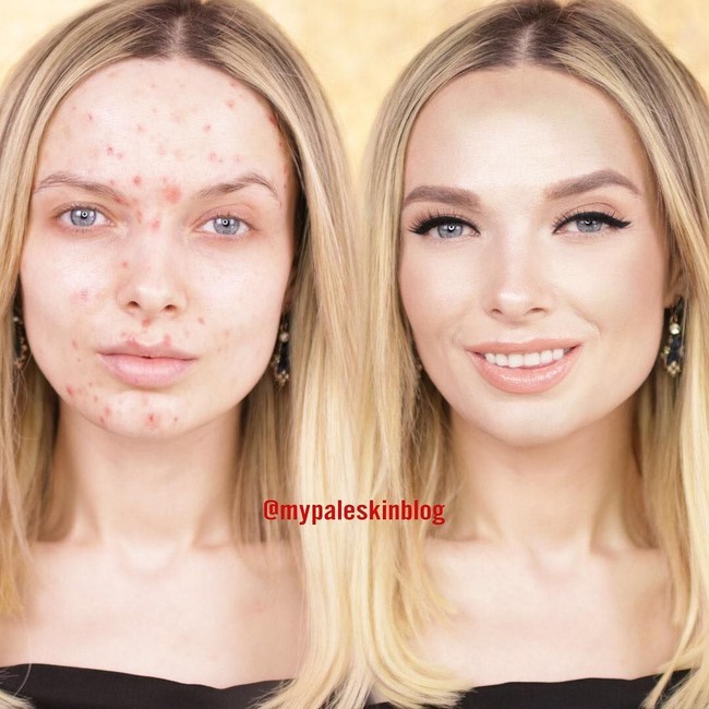 Di 2015 aku pun memutuskan untuk mengambil alih hidupku dengan membahas tentang jerawat ku dan menunjukkan wajahnya dengan dan tanpa mkeup di media sosial dan Youtube, ujar wanita 27 tahun itu.  Foto: Dok. Instagram/Em Ford