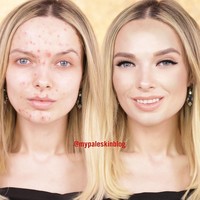 Di 2015 aku pun memutuskan untuk mengambil alih hidupku dengan membahas tentang jerawat ku dan menunjukkan wajahnya dengan dan tanpa mkeup di media sosial dan Youtube, ujar wanita 27 tahun itu.  Foto: Dok. Instagram/Em Ford