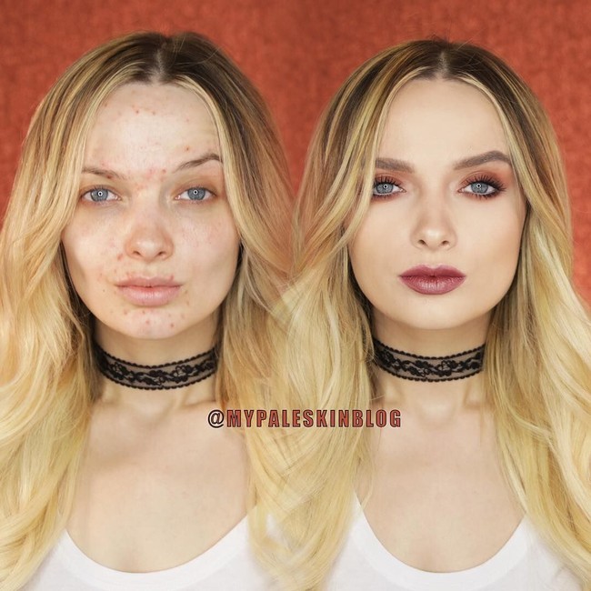 Em pun menerima banyak dukungan dari netizen, terlebih yang memiliki kondisi kulit yang sama dengannya. Dalam videonya, Em memperlihatkan teknik makeup-nya yang membuat wajahnya yang berjerawat bertransformasi jadi kulit yang super flawless.  Foto: Dok. Instagram/Em Ford